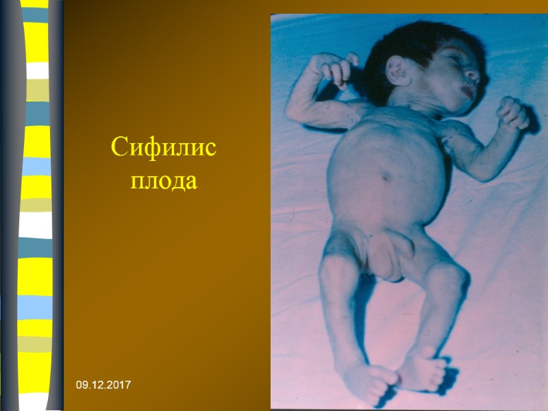 09.12.2017 Сифилис плода